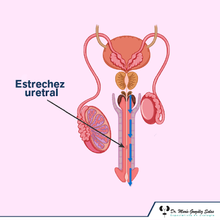 Estrechez uretral: cómo afecta la calidad de vida y qué señales no deben ignorarse